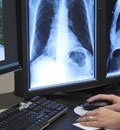 Dell-object based storage X-ray image on monitor of lungs