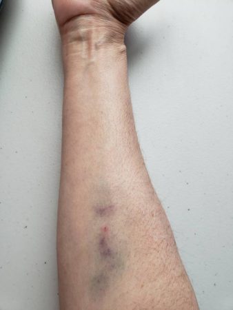 Bruise at IV site Colonoscopy